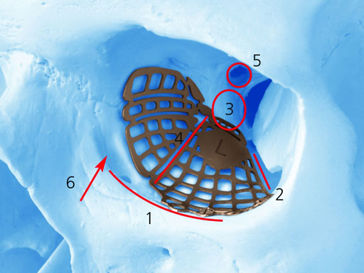 MatrixPreformedOrbitalPlates_3